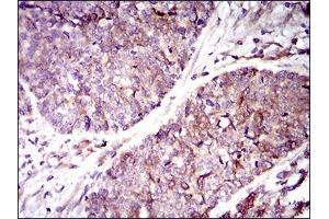 Immunohistochemical analysis of paraffin-embedded esophageal cancer tissues using GUCY1A3 mouse mAb with DAB staining.