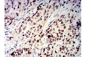 Immunohistochemical analysis of paraffin-embedded bladder cancer tissues using CIRBP mouse mAb with DAB staining. (CIRBP anticorps  (AA 1-90))
