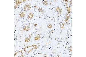 Immunohistochemistry of paraffin-embedded human breast cancer using ETV1 antibody. (ETV1 anticorps)