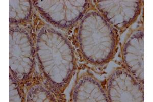 IHC image of ABIN7156171 diluted at 1:200 and staining in paraffin-embedded human colon cancer performed on a Leica BondTM system.