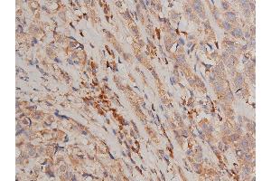ABIN6267231 at 1/50 staining human breast cancer tissue sections by IHC-P.