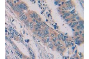 Detection of PTK7 in Human Colorectal cancer Tissue using Polyclonal Antibody to Tyrosine Protein Kinase 7 (PTK7)