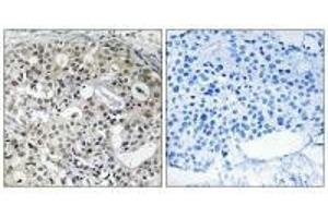 Immunohistochemistry analysis of paraffin-embedded human breast carcinoma tissue using CNTD2 antibody. (CNTD2 anticorps)