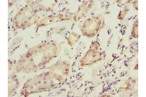 Immunohistochemistry of paraffin-embedded human gastric cancer using ABIN7165283 at dilution of 1:100
