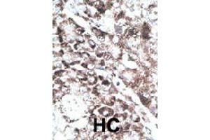 Formalin-fixed and paraffin-embedded human hepatocellular carcinoma tissue reacted with GPR37 polyclonal antibody  , which was peroxidase-conjugated to the secondary antibody, followed by DAB staining . (GPR37 anticorps  (C-Term))