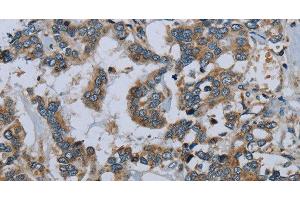 Immunohistochemistry of paraffin-embedded Human liver cancer using PCK2 Polyclonal Antibody at dilution of 1:60