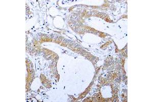 Immunohistochemical analysis of BCLX (pT47) staining in human colon cancer formalin fixed paraffin embedded tissue section. (BCL2L1 anticorps  (pSer47))