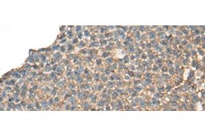 Immunohistochemistry of paraffin-embedded Human ovarian cancer tissue using CABP5 Polyclonal Antibody at dilution of 1:65(x200) (CABP5 anticorps)