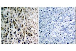 Immunohistochemical analysis of paraffin- embedded human lung carcinoma tissue using Chk2 (phospho-Thr68) antibody (E011061). (CHEK2 anticorps  (pThr68))
