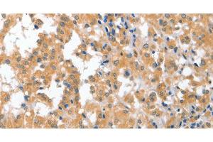 Immunohistochemistry of paraffin-embedded Human thyroid cancer tissue using CDR2 Polyclonal Antibody at dilution 1:60 (CDR2 anticorps)