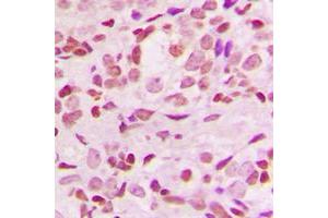 Immunohistochemical analysis of IKB alpha staining in human breast cancer formalin fixed paraffin embedded tissue section.