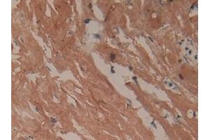 Detection of COL1a1 in Human Breast cancer Tissue using Polyclonal Antibody to Collagen Type I Alpha 1 (COL1a1)