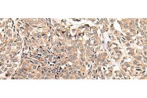 Immunohistochemistry of paraffin-embedded Human esophagus cancer tissue using LDAH Polyclonal Antibody at dilution of 1:55(x200)