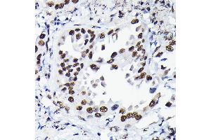 Immunohistochemistry of paraffin-embedded human lung cancer using HDGF Rabbit pAb  at dilution of 1:50 (40x lens).