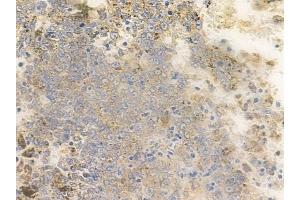 ABIN6258694 and ABIN6274786 at 1/100 staining human melanoma by IHC-P.