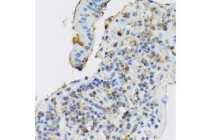 Immunohistochemistry of paraffin-embedded human gastric cancer using CD117/c-Kit antibody (ABIN6133454, ABIN6142896, ABIN6142898 and ABIN6213818) at dilution of 1:150 (40x lens). (KIT anticorps  (AA 25-295))