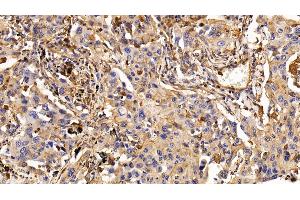 Detection of EGFR in Human Lung cancer Tissue using Monoclonal Antibody to Epidermal Growth Factor Receptor (EGFR) (EGFR anticorps  (AA 888-1210))