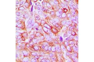 Immunohistochemical analysis of CD61 (pY773) staining in human breast cancer formalin fixed paraffin embedded tissue section.