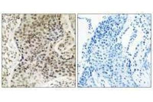 Immunohistochemistry analysis of paraffin-embedded human lung carcinoma tissue, using TSEN54 antibody.