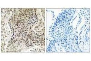 Immunohistochemistry analysis of paraffin-embedded human lung carcinoma tissue, using TSEN54 antibody. (TSEN54 anticorps)