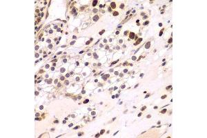 Immunohistochemistry of paraffin-embedded human kidney cancer using CEBPG antibody.