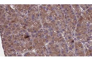 ABIN6273980 at 1/100 staining Human liver cancer tissue by IHC-P. (OR2M4 anticorps)