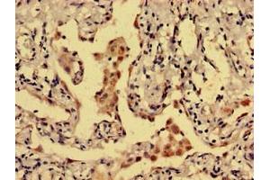 Immunohistochemistry analysis of human lung cancer using ABIN7149466 at dilution of 1:100 (Dopamine Receptor d1 anticorps  (AA 338-446))