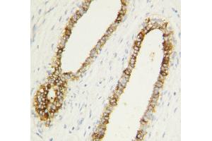 Anti-Caspase-1(P10) antibody, IHC(P) IHC(P): Human Mammary Cancer Tissue (Caspase 1 anticorps  (C-Term))