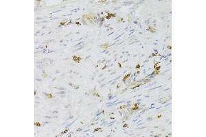 Immunohistochemistry of paraffin-embedded human adenomyosis using LSP1 Antibody (ABIN6130532, ABIN6143368, ABIN6143370 and ABIN6221252) at dilution of 1:100 (40x lens).