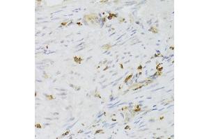Immunohistochemistry of paraffin-embedded human adenomyosis using LSP1 Antibody (ABIN6130532, ABIN6143368, ABIN6143370 and ABIN6221252) at dilution of 1:100 (40x lens). (LSP1 anticorps  (AA 1-339))