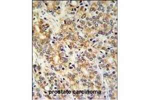 TXNDC12 Antibody (C-term) (ABIN651065 and ABIN2840056) IHC analysis in formalin fixed and paraffin embedded prostate carcinoma followed by peroxidase conjugation of the secondary antibody and DAB staining. (TXNDC12 anticorps  (C-Term))