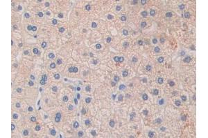 IHC-P analysis of Human Liver cancer Tissue, with DAB staining. (GLDC anticorps  (AA 81-268))