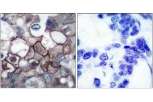 Immunohistochemistry analysis of paraffin-embedded human breast carcinoma, using EGFR (Phospho-Tyr1197) Antibody.