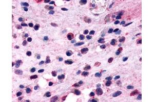 Anti-GPR44 / CRTH2 antibody IHC of human nasal mucosa, eosinophils.