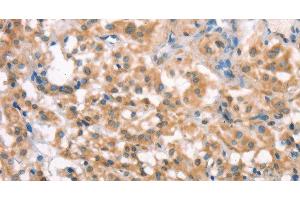 Immunohistochemistry of paraffin-embedded Human thyroid cancer tissue using LATS2 Polyclonal Antibody at dilution 1:30 (LATS2 anticorps)