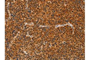 The image on the left is immunohistochemistry of paraffin-embedded Human liver cancer tissue using ABIN7129834(IKZF3 Antibody) at dilution 1/60, on the right is treated with fusion protein. (IKZF3 anticorps)