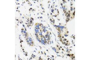 Immunohistochemistry of paraffin-embedded human gastric cancer using TOP1 antibody. (Topoisomerase I anticorps)