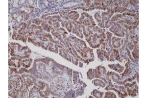 IHC staining of formalin fixed and paraffin embedded thyroid carcinoma tissue with recombinant BRAF V600E antibody. (Recombinant BRAF anticorps  (V600E))