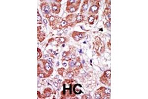 Formalin-fixed and paraffin-embedded human cancer tissue reacted with the primary antibody, which was peroxidase-conjugated to the secondary antibody, followed by DAB staining.