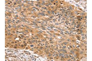 The image on the left is immunohistochemistry of paraffin-embedded Human esophagus cancer tissue using ABIN7131123(SNX11 Antibody) at dilution 1/30, on the right is treated with fusion protein. (SNX11 anticorps)