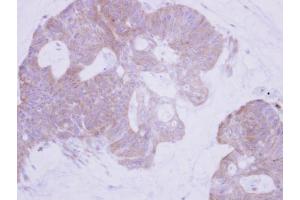 IHC-P Image Immunohistochemical analysis of paraffin-embedded human colon carcinoma, using PTER, antibody at 1:500 dilution. (PTER anticorps)