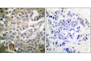 Immunohistochemistry analysis of paraffin-embedded human breast carcinoma tissue, using Rac1/CDC42 (Ab-71) Antibody. (RAC1+CDC42 (AA 38-87) anticorps)