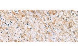 Immunohistochemistry of paraffin-embedded Human liver cancer tissue using GPC2 Polyclonal Antibody at dilution of 1:40(x200) (GPC2 anticorps)