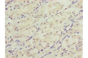 Immunohistochemistry of paraffin-embedded human gastric cancer using ABIN7150132 at dilution of 1:100