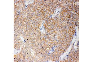 Anti-Caspase-12 antibody, IHC(P) IHC(P): Human Lung Cancer Tissue (Caspase 12 anticorps  (N-Term))