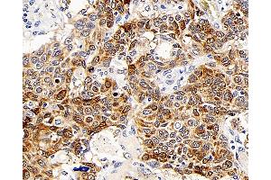 Immunohistochemistry analysis of paraffin-embedded human lung cancer using CD107b Polyclonal Antibody at dilution of 1:300. (LAMP2 anticorps)