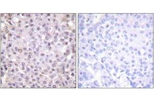 Immunohistochemistry analysis of paraffin-embedded human breast carcinoma tissue, using NCoR1 Antibody. (NCOR1 anticorps  (AA 51-100))