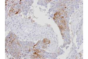 IHC-P Image Immunohistochemical analysis of paraffin-embedded human lung SCC, using RanBP16, antibody at 1:100 dilution.