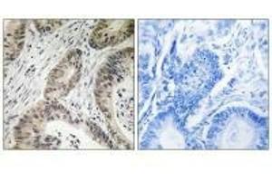 Immunohistochemistry analysis of paraffin-embedded human colon carcinoma tissue using TUT1 antibody. (TUT1 anticorps)