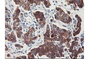 Immunohistochemical staining of paraffin-embedded Carcinoma of Human lung tissue using anti-FDFT1 mouse monoclonal antibody. (FDFT1 anticorps)